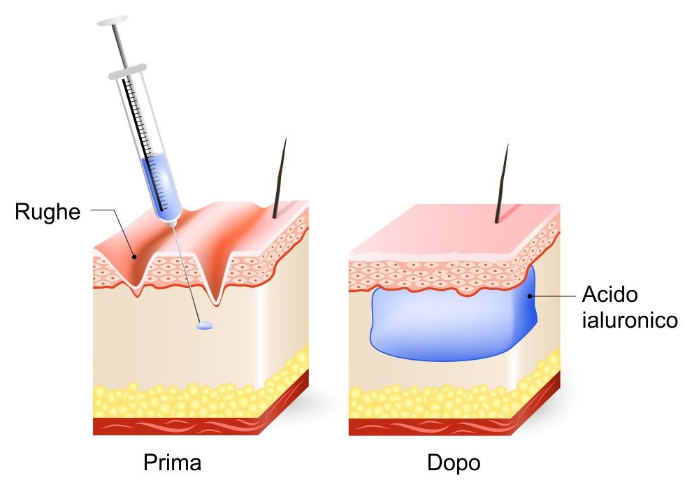 acido ialuronico